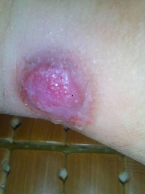 挖鸡眼全部过程视频,一图看懂挖鸡眼全过程